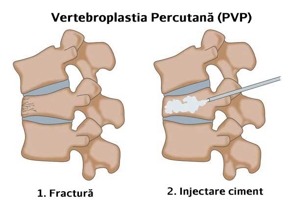 Vertebroplastia Percutana (PVP)